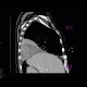 Pneumonia, liquefaction: CT - Computed tomography