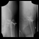 Necrosis of femoral head, osteonecrosis and hardware failure: X-ray - Plain radiograph