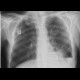 Lung cavity, pneumothorax, hydropneumothorax: X-ray - Plain radiograph