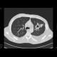 Lung cavity, pneumothorax, hydropneumothorax: CT - Computed tomography