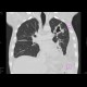 Lung cavity, pneumothorax, hydropneumothorax: CT - Computed tomography