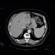 Cholangiocellular carcinoma of liver, dilation of intrahepatic ducts: CT - Computed tomography
