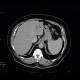 Cholangiocellular carcinoma of liver, dilation of intrahepatic ducts: CT - Computed tomography