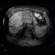Cholangiocellular carcinoma of liver, dilation of intrahepatic ducts: MRI - Magnetic Resonance Imaging