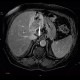 Cholangiocellular carcinoma of liver, dilation of intrahepatic ducts: MRI - Magnetic Resonance Imaging