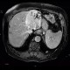 Cholangiocellular carcinoma of liver, dilation of intrahepatic ducts: MRI - Magnetic Resonance Imaging