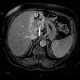 Cholangiocellular carcinoma of liver, dilation of intrahepatic ducts: MRI - Magnetic Resonance Imaging