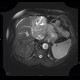 Cholangiocellular carcinoma of liver, dilation of intrahepatic ducts: MRI - Magnetic Resonance Imaging