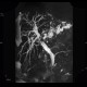 Cholangiocellular carcinoma of liver, dilation of intrahepatic ducts: MRI - Magnetic Resonance Imaging
