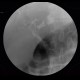 Cholangiocellular carcinoma of liver, dilation of intrahepatic ducts, ERCP: RF - Fluoroscopy