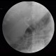 Cholangiocellular carcinoma of liver, dilation of intrahepatic ducts, ERCP: RF - Fluoroscopy