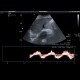 Dilated hepatic veins: US - Ultrasound