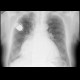 Enlarged heart: X-ray - Plain radiograph