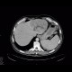 Dilated intrahepatic bile ducts in the left liver lobe, biliodigestive anastomosis, pneumobilia: CT - Computed tomography