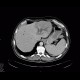 Dilated intrahepatic bile ducts in the left liver lobe, biliodigestive anastomosis, pneumobilia: CT - Computed tomography