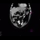 Dilated intrahepatic bile ducts in the left liver lobe, biliodigestive anastomosis, pneumobilia: CT - Computed tomography