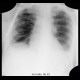 Forked rib: X-ray - Plain radiograph