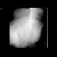 Development of ileus: X-ray - Plain radiograph