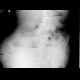 Development of ileus: X-ray - Plain radiograph