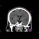 Brain ischemia, MCA, day 1: CT - Computed tomography