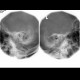Rundstrom view, chronic mastoiditis: X-ray - Plain radiograph
