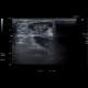 rupture of Achilles tendon: US - Ultrasound