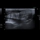 rupture of Achilles tendon: US - Ultrasound