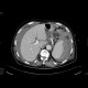 Rupture of the spleen: CT - Computed tomography