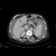 Rupture of the spleen: CT - Computed tomography