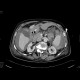 Rupture of the spleen: CT - Computed tomography