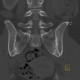 Sacroileitis: CT - Computed tomography