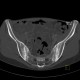 Sacroileitis: CT - Computed tomography