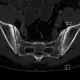 Sacroileitis, Crohn's disease: CT - Computed tomography