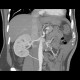 Polar artery, accessory renal artery: CT - Computed tomography