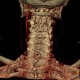 Separation of spinous process of C6 and C7, congenital: CT - Computed tomography