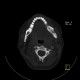 SAPHO syndrome: CT - Computed tomography