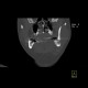 SAPHO syndrome: CT - Computed tomography