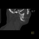 SAPHO syndrome: CT - Computed tomography