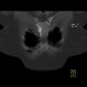 SAPHO syndrome: CT - Computed tomography