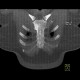 SAPHO syndrome: CT - Computed tomography