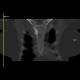 SAPHO syndrome: CT - Computed tomography