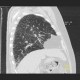 Sarcoidosis of lung, HRCT, hilar lymphadenopathy: CT - Computed tomography