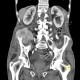 Sarcoma of iliac crest: CT - Computed tomography