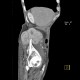 Sarcoma of iliac crest: CT - Computed tomography