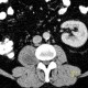Schwannoma of psoas muscle: CT - Computed tomography
