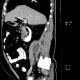 Schwannoma of psoas muscle: CT - Computed tomography