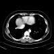 Scimitar syndrom, anomalous return of pulmonary vein: CT - Computed tomography
