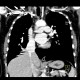 Scimitar syndrom, anomalous return of pulmonary vein: CT - Computed tomography