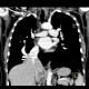 Scimitar syndrom, anomalous return of pulmonary vein: CT - Computed tomography