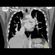 Scimitar syndrom, anomalous return of pulmonary vein: CT - Computed tomography